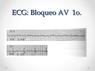 ECG: Bloqueo AV 1o.ECG: Bloqueo AV 1o.
 