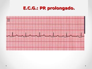 E.C.G.: PR prolongado.E.C.G.: PR prolongado.
1.
 