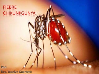 FIEBRE
CHIKUNKGUNYA
Por:
Dra. Yocelyn Guerrero
 