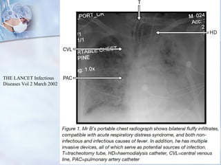 THE LANCET Infectious Diseases Vol 2 March 2002 