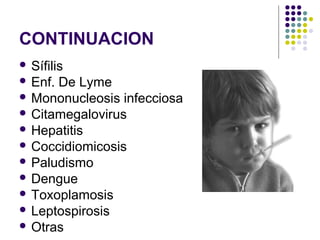 CONTINUACION
 Sífilis
 Enf. De Lyme
 Mononucleosis infecciosa
 Citamegalovirus
 Hepatitis
 Coccidiomicosis
 Paludismo
 Dengue
 Toxoplamosis
 Leptospirosis
 Otras
 