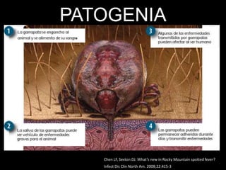 PATOGENIA
Chen LF, Sexton DJ. What’s new in Rocky Mountain spotted fever?
Infect Dis Clin North Am. 2008;22:415-3
 