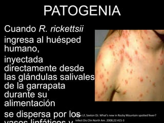 PATOGENIA
Cuando R. rickettsii
ingresa al huésped
humano,
inyectada
directamente desde
las glándulas salivales
de la garrapata
durante su
alimentación
se dispersa por losChen LF, Sexton DJ. What’s new in Rocky Mountain spotted fever?
Infect Dis Clin North Am. 2008;22:415-3
 