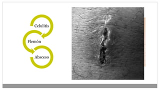 Celulitis
Flemón
Absceso
 
