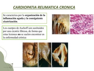 fiebre reumática, cardiopatia bacteria.pptx