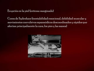 Erupción en la piel (eritema marginado)

Corea de Sydenham (inestabilidad emocional, debilidad muscular y
movimientos convulsivos espasmódicos descoordinados y rápidos que
afectan principalmente la cara, los pies y las manos)
 