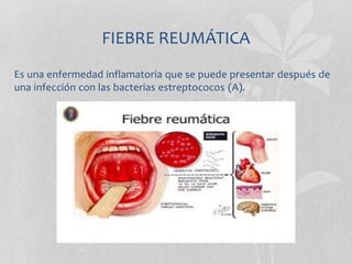 FIEBRE REUMÁTICA
Es una enfermedad inflamatoria que se puede presentar después de
una infección con las bacterias estreptococos (A).
 