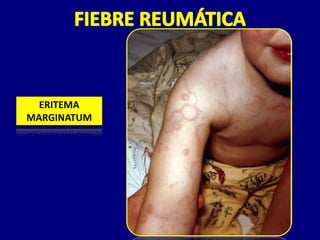 ERITEMA
MARGINATUM
 