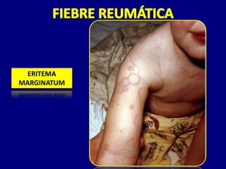 ERITEMA
MARGINATUM
 