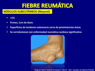 NÓDULOS SUBCUTÁNEOS (Meynet)
  <1%
  Firmes, 1cm de diam.
  Superficies de tendones extensores cerca de prominencias óseas
  Se correlacionan con enfermedad reumática cardiaca significativa




                          Kliegman: Nelson Textbook of Pediatrics, 19th ed. - 2011 - Saunders, An Imprint of Elsevier
 