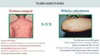 Fiebre Reumática en pediatría según aeped.pptx