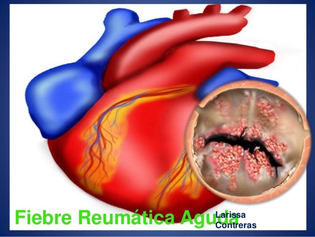 fiebre reumatica