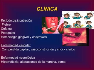 CLÍNICA

Período de incubación
Fiebre
Cefalea
Petequias
Hemorragia gingival y conjuntival

Enfermedad vascular
Con pérdida capilar, vasoconstricción y shock clínico

Enfermedad neurológica
Hiporreflexia, alteraciones de la marcha, coma.
 
