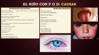 EL NIÑO CON F O D: CAUSAS
 