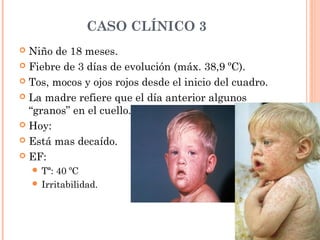 CASO CLÍNICO 3
 Niño de 18 meses.
 Fiebre de 3 días de evolución (máx. 38,9 ºC).
 Tos, mocos y ojos rojos desde el inicio del cuadro.
 La madre refiere que el día anterior algunos
“granos” en el cuello.
 Hoy:
 Está mas decaído.
 EF:
 Tª: 40 ºC
 Irritabilidad.
 
