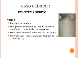 CASO CLÍNICO 5
EXANTEMA SÚBITO
 VHH-6:
 Latencia en cerebro.
 Integración cromosómica, dando infección
congénita, transmitida por los padres.
 90 % niños seropositivos antes de los 3 años.
 Convulsiones febriles en niños después de los
2 años. (33%).
 