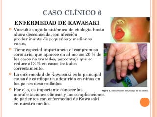 CASO CLÍNICO 6
ENFERMEDAD DE KAWASAKI
 Afecta predominantemente a < de 5 años
(80 % < de 4 años).
 Epidemiología esporád...