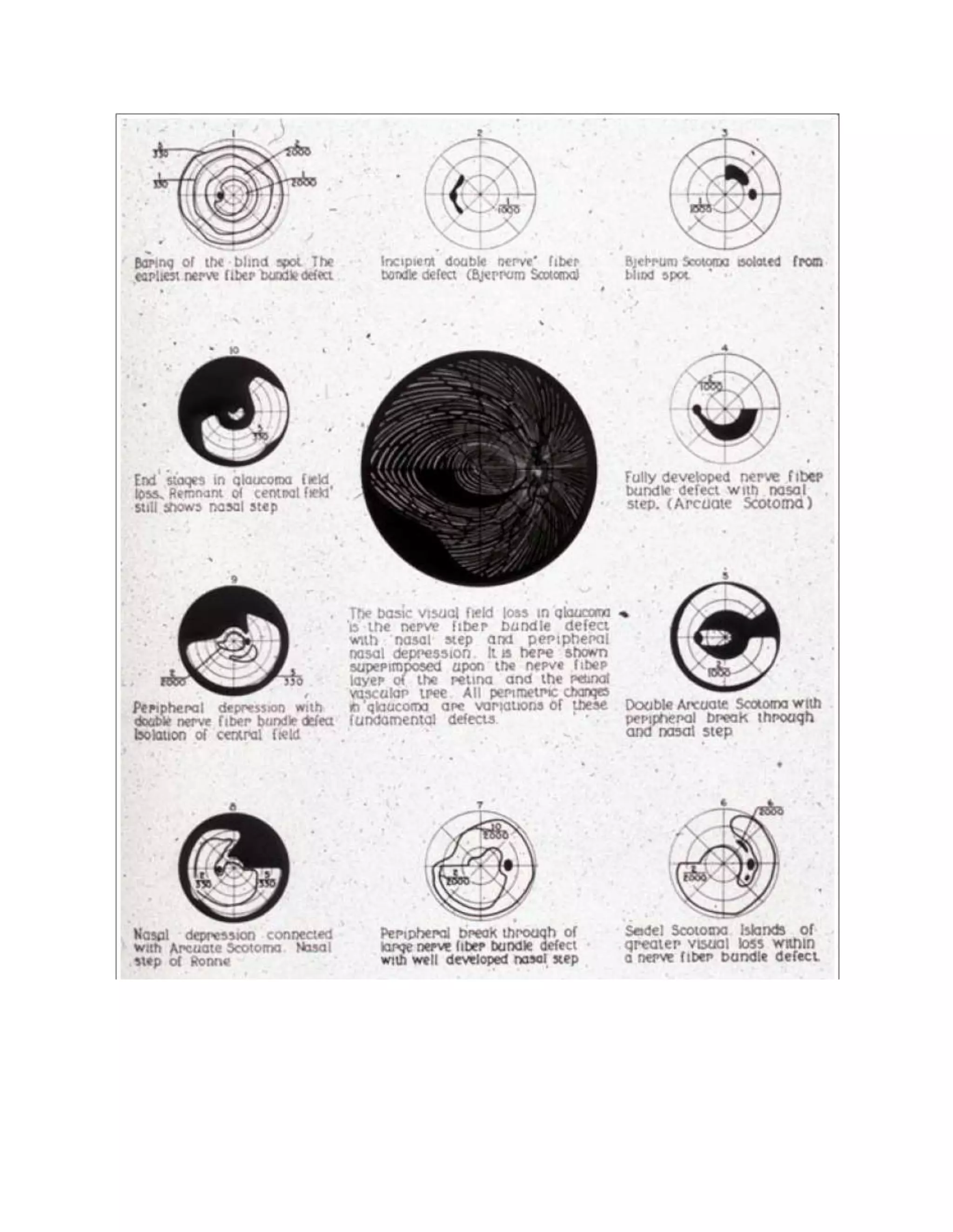 Field changes in glaucoma