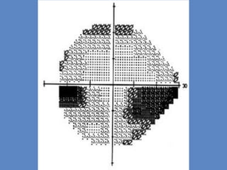 Comprehensive Overview of Visual Field Defects in Glaucoma Diagnosis ...