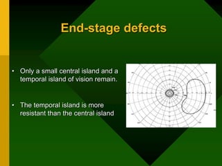 End-stage defects
• Only a small central island and a
temporal island of vision remain.
• The temporal island is more
resistant than the central island
 