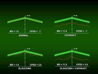 40 dB
40 dB 40 dB
40 dB
40 dB
40 dB 40 dB
40 dB
MD = 1.9
MD = 1.9
MD = 11.9
MD = 11.9
CPSD = .7
CPSD = 2.6 CPSD = 2.6
CPSD = .7
NORMAL CATARACT
GLAUCOMA GLAUCOMA + CATARACT
 