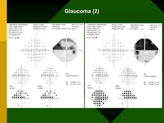 Glaucoma (2)
 