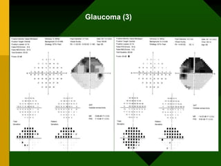 Glaucoma (3)
 