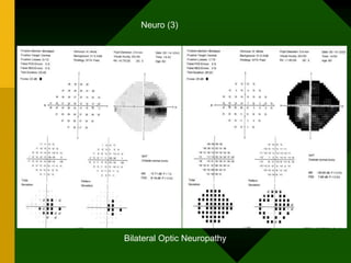 Bilateral Optic Neuropathy
Neuro (3)
 