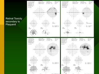Retinal Toxicity
secondary to
Plaquenil
 