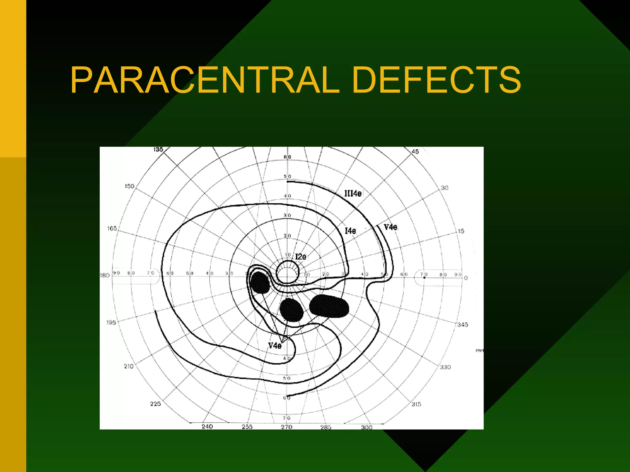 PARACENTRAL DEFECTS 