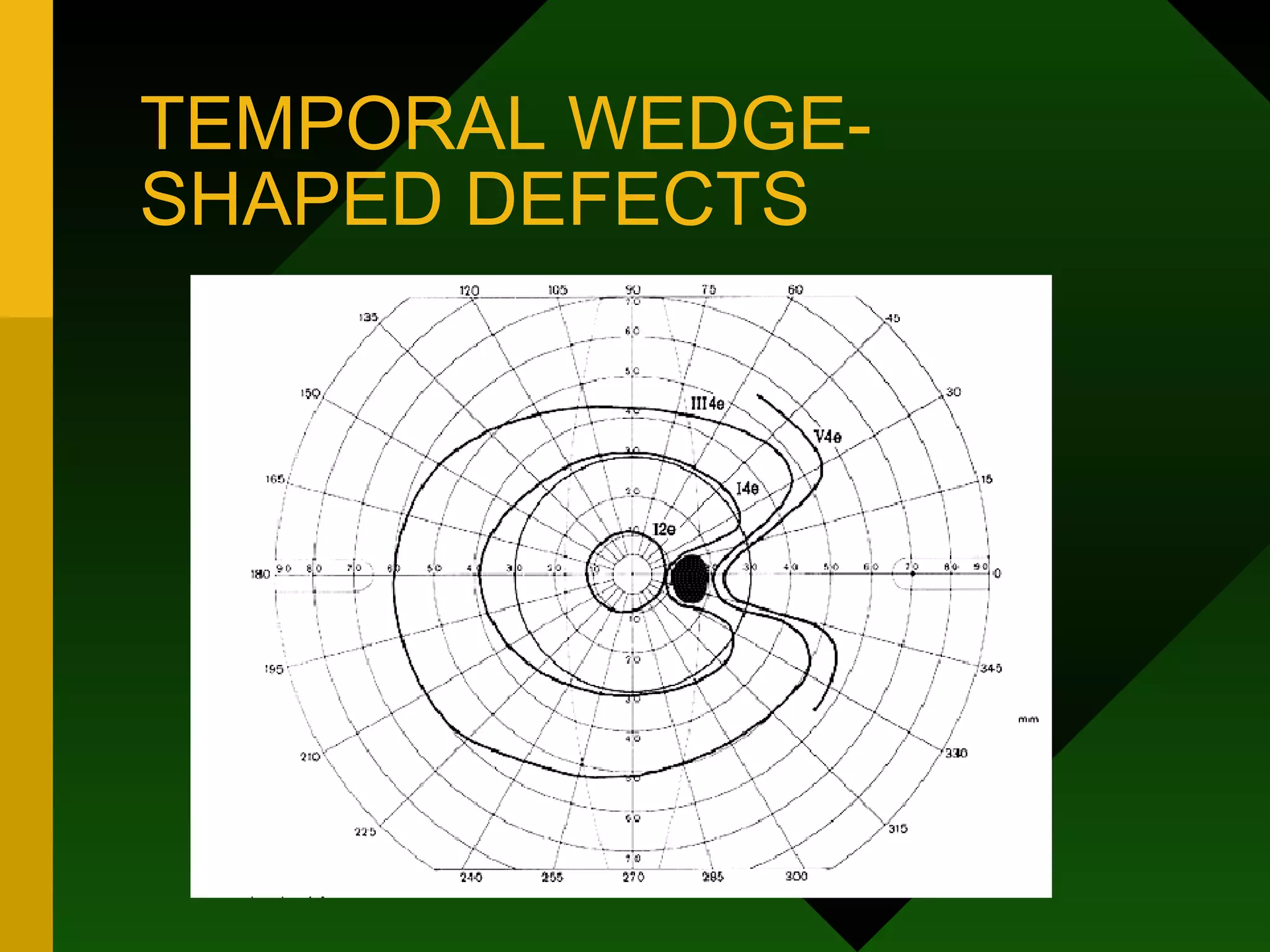 TEMPORAL WEDGE-SHAPED DEFECTS 