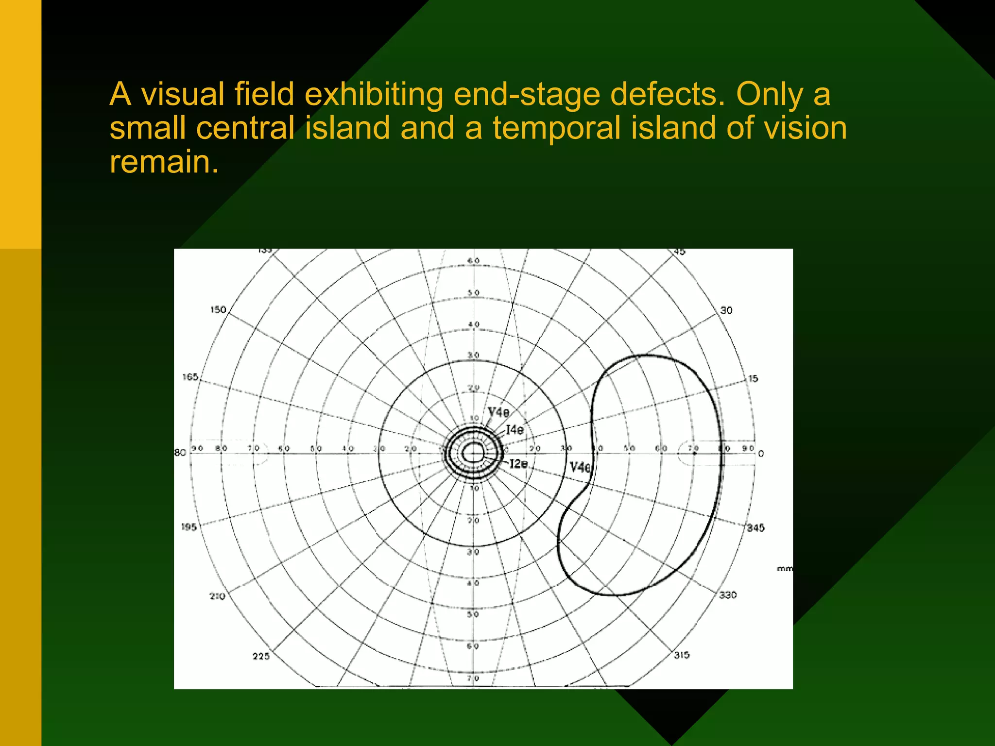 A visual field exhibiting end-stage defects. Only a small central island and a temporal island of vision remain. 