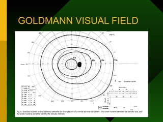 GOLDMANN VISUAL FIELD
 