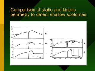 Comparison of static and kinetic
perimetry to detect shallow scotomas
 