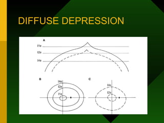 DIFFUSE DEPRESSION
 