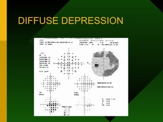 DIFFUSE DEPRESSION
 