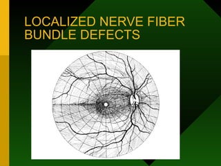 LOCALIZED NERVE FIBER
BUNDLE DEFECTS
 