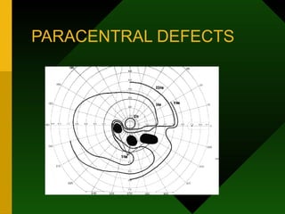 PARACENTRAL DEFECTS
 