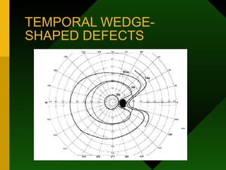 TEMPORAL WEDGE-
SHAPED DEFECTS
 