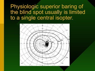 Physiologic superior baring of
the blind spot usually is limited
to a single central isopter.
 