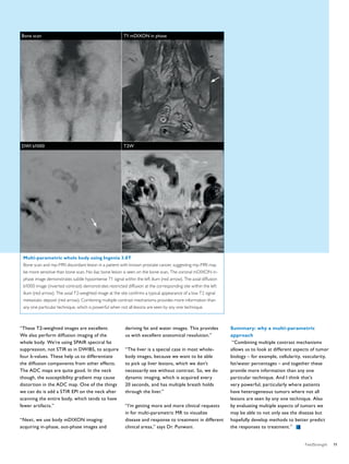 “These T2-weighted images are excellent. 
We also perform diffusion imaging of the 
whole body. We’re using SPAIR spectral fat 
suppression, not STIR as in DWIBS, to acquire 
four b-values. These help us to differentiate 
the diffusion components from other effects. 
The ADC maps are quite good. In the neck 
though, the susceptibility gradient may cause 
distortion in the ADC map. One of the things 
we can do is add a STIR EPI on the neck after 
scanning the entire body, which tends to have 
fewer artifacts.” 
“Next, we use body mDIXON imaging: 
acquiring in-phase, out-phase images and 
deriving fat and water images. This provides 
us with excellent anatomical resolution.” 
“The liver is a special case in most whole-body 
images, because we want to be able 
to pick up liver lesions, which we don’t 
necessarily see without contrast. So, we do 
dynamic imaging, which is acquired every 
20 seconds, and has multiple breath holds 
through the liver.” 
“I’m getting more and more clinical requests 
in for multi-parametric MR to visualize 
disease and response to treatment in different 
clinical areas,” says Dr. Punwani. 
Summary: why a multi-parametric 
approach 
“Combining multiple contrast mechanisms 
allows us to look at different aspects of tumor 
biology – for example, cellularity, vascularity, 
fat/water percentages – and together these 
provide more information than any one 
particular technique. And I think that’s 
very powerful, particularly where patients 
have heterogeneous tumors where not all 
lesions are seen by any one technique. Also 
by evaluating multiple aspects of tumors we 
may be able to not only see the disease but 
hopefully develop methods to better predict 
the responses to treatment.” 
Bone scan 
DWI b1000 
T1 mDIXON in phase 
T2W 
Multi-parametric whole body using Ingenia 3.0T 
Bone scan and mp-MRI discordant lesion in a patient with known prostate cancer, suggesting mp-MRI may 
be more sensitive than bone scan. No iliac bone lesion is seen on the bone scan. The coronal mDIXON in-phase 
image demonstrates subtle hypointense T1 signal within the left ilium (red arrow). The axial diffusion 
b1000 image (inverted contrast) demonstrates restricted diffusion at the corresponding site within the left 
ilium (red arrow). The axial T2-weighted image at the site confirms a typical appearance of a low T2 signal 
metastatic deposit (red arrow). Combining multiple contrast mechanisms provides more information than 
any one particular technique, which is powerful when not all lesions are seen by any one technique. 
FieldStrength 11 
 