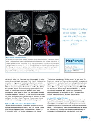 “We are moving from doing 
several studies – CT first, 
then MR or PET – to just 
one, and it’s saving us a lot 
NetForum 
www.philips.com/netforum 
Visit the online NetForum 
community to download the liver 
ExamCard of Prof. Valette. 
CONTINUE 
was recently added. Prof. Valette likes using the Ingenia’s dS Torso coil 
solution because it has a large coverage. “With this coil, whole abdomen 
acquisition is a single step for most patients. So, it is much faster to 
perform, for instance, bowel MRI for inflammatory diseases or tumors.” 
With the most recent Ingenia software release installed, Prof. Valette 
has worked to improve reproducibility, image quality and acquisition 
time of the hospital’s liver sequences. “We were able to realize 
improvements thanks to high dS SENSE in RL direction and improved 
MultiVane T2-weighted imaging. We are now convinced that we are on 
the way to definitely overcome the challenges. We optimized for image 
quality and control of artifacts. The arterial phase detection of very 
small liver or pancreatic hypervascular tumors is also improved.” 
Only one MRI exam instead of multiple studies 
“With all these improvements, I believe that resolution of vascular 
liver MR imaging is now approaching CT,” says Prof. Valette. “That’s 
important because we are moving from doing several studies - CT 
first, then MR or PET – to just one, and it’s saving a lot of time.” 
of time.” 
“For instance, when assessing bile duct tumors, we need to see the 
location and boundaries of the tumor, but also the bile ducts adjacent 
to the tumor, the vessels, the hepatic artery, the portal vein, because 
all these are needed to determine whether the tumor is resectable 
or not. When we get, for example, bile duct images from MR or CT 
and the tumor on PET and maybe the vessels from CT, it’s difficult 
to combine all these views. And it means two or maybe three 
examinations have to be performed. The idea is to do everything 
with just one multiparametric technique, and that is MRI.” 
A robust high quality MRI exam 
Prof. Valette’s liver MRI includes some basic sequences and a set of 
optional sequences that may be used in special circumstances. “Our 
extended liver ExamCard includes a range of sequences for patients 
with limited capability to hold their breath, and also for obese patients,” 
he says. “If the patient is not able to maintain a breath hold we reduce 
the acquisition time by limiting the coverage to a selected region of 
interest and/or increase the voxel size, depending on the case.” 
T1 mDIXON arterial phase 
T2W 
T1W mDIXON portal phase 
VRT liver vessels 
Focal nodular hyperplasia in liver 
In a 45-year-old woman recently operated for a breast cancer, ultrasound revealed a right hepatic nodular 
lesion. T1-weighted images at arterial and late phase demonstrate a small mass, markedly hypervascular at 
the arterial phase, isointense to the liver at the late phase except persistent enhancement of fibrous septa, 
making a characteristic aspect of FNH. On the T2-weighted image the nodule is moderately hyperintense. 
The 3D image demonstrates the spatial arrangement of the hepatic artery, the portal vein and hepatic 
veins showing the anatomical relationship of the hepatic nodule with the vascular liver structures. 
Ingenia 3.0T with dS Torso coil solution, patient feet first, arms up. 
FieldStrength 13 
 