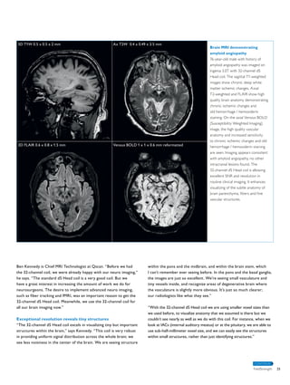 Ben Kennedy is Chief MRI Technologist at Qscan. “Before we had 
the 32-channel coil, we were already happy with our neuro imaging,” 
he says. “The standard dS Head coil is a very good coil. But we 
have a great interest in increasing the amount of work we do for 
neurosurgeons. The desire to implement advanced neuro imaging, 
such as fiber tracking and fMRI, was an important reason to get the 
32-channel dS Head coil. Meanwhile, we use the 32-channel coil for 
all our brain imaging now.” 
Exceptional resolution reveals tiny structures 
“The 32-channel dS Head coil excels in visualizing tiny but important 
structures within the brain,” says Kennedy. “This coil is very robust 
in providing uniform signal distribution across the whole brain; we 
see less noisiness in the center of the brain. We are seeing structure 
within the pons and the midbrain, and within the brain stem, which 
I can’t remember ever seeing before. In the pons and the basal ganglia, 
the images are just so excellent. We’re seeing small vasculature and 
tiny vessels inside, and recognize areas of degenerative brain where 
the vasculature is slightly more obvious. It’s just so much clearer; 
our radiologists like what they see.” 
“With the 32-channel dS Head coil we are using smaller voxel sizes than 
we used before, to visualize anatomy that we assumed is there but we 
couldn’t see nearly as well as we do with this coil. For instance, when we 
look at IACs (internal auditory meatus) or at the pituitary, we are able to 
use sub-half-millimeter voxel size, and we can easily see the structures 
within small structures, rather than just identifying structures.” 
CONTINUE 
3D T1W 0.5 x 0.5 x 2 mm 
3D FLAIR 0.6 x 0.8 x 1.5 mm 
Ax T2W 0.4 x 0.49 x 3.5 mm 
Venous BOLD 1 x 1 x 0.6 mm reformatted 
Brain MRI demonstrating 
amyloid angiopathy 
76-year-old male with history of 
amyloid angiopathy was imaged on 
Ingenia 3.0T with 32-channel dS 
Head coil. The sagittal T1-weighted 
images show chronic deep white 
matter ischemic changes. Axial 
T2-weighted and FLAIR show high 
quality brain anatomy demonstrating 
chronic ischemic changes and 
old hemorrhage / hemosiderin 
staining. On the axial Venous BOLD 
(Susceptibility Weighted Imaging) 
image, the high quality vascular 
anatomy and increased sensitivity 
to chronic ischemic changes and old 
hemorrhage / hemosiderin staining 
are seen. Imaging appears consistent 
with amyloid angiopathy, no other 
intracranial lesions found. The 
32-channel dS Head coil is allowing 
excellent SNR and resolution in 
routine clinical imaging. It enhances 
visualizing of the subtle anatomy of 
brain parenchyma, fibers and fine 
vascular structures. 
FieldStrength 25 
 
