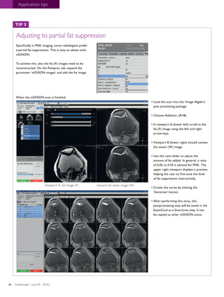 Application tips 
Adjusting to partial fat suppression 
Specifically in MSK imaging, some radiologists prefer 
a partial fat suppression. This is easy to obtain with 
mDIXON. 
To achieve this, also the fat (F) images need to be 
reconstructed. On the Postproc tab, expand the 
parameter ‘mDIXON images’ and add the fat image. 
When the mDIXON scan is finished: 
• Load the scan into the ‘Image Algebra’ 
post processing package. 
• Choose Addition: (A+B). 
• In viewport A (lower left) scroll to the 
fat (F) image using the left and right 
arrow keys. 
• Viewport B (lower right) should contain 
the water (W) image. 
• Use the ratio slider to adjust the 
amount of fat added. In general, a ratio 
of 0.05 to 0.10 is advised for MSK. The 
upper right viewport displays a preview, 
helping the user to fine-tune the level 
of fat suppression interactively. 
• Create the series by clicking the 
‘Generate’ button. 
• After performing this once, this 
postprocessing step will be saved in the 
ExamCard as a SmartLine step. It can 
be copied to other mDIXON scans. 
TIP 5 
Viewport A, fat image (F) Viewport B, water image (W) 
FieldStrength - I 36 ssue 49 - 2013/2 
 