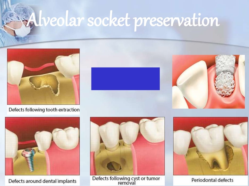 application of bone graft in dentistry