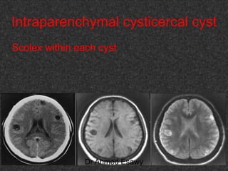 Fifteen (50) intracranial cystic lesion Dr Ahmed Esawy CT MRI main  Slide 110