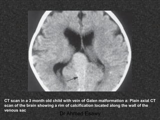 Fifteen (50) intracranial cystic lesion Dr Ahmed Esawy CT MRI main  Slide 123