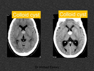 Fifteen (50) intracranial cystic lesion Dr Ahmed Esawy CT MRI main  Slide 142