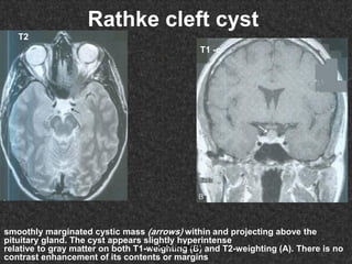 Fifteen (50) intracranial cystic lesion Dr Ahmed Esawy CT MRI main  Slide 149
