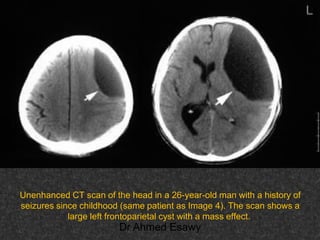 Fifteen (50) intracranial cystic lesion Dr Ahmed Esawy CT MRI main  Slide 15